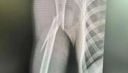 10岁男孩遭遇洗衣机“陷阱”，右臂粉碎性骨折！医生提醒
